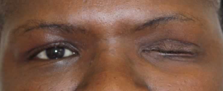 I Lost my Eye - Eyes Alive
